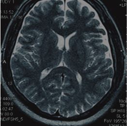 MRI of a traumatic brain injury